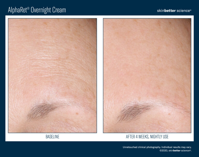 AlphaRet Before & After Template_2020(HQP)4