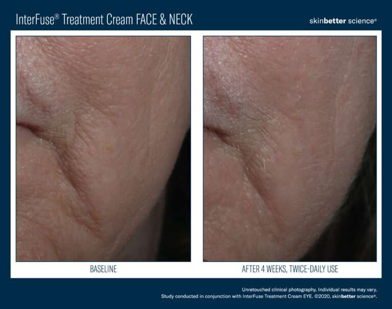 InterFuse FACE & NECK Before & After Template_2020(HQP)8
